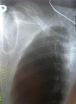 Broken collar bone